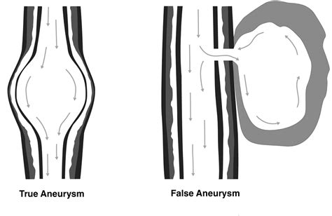 true aneurysm vs false